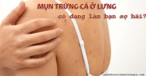 Cách trị mụn trứng cá ở lưng