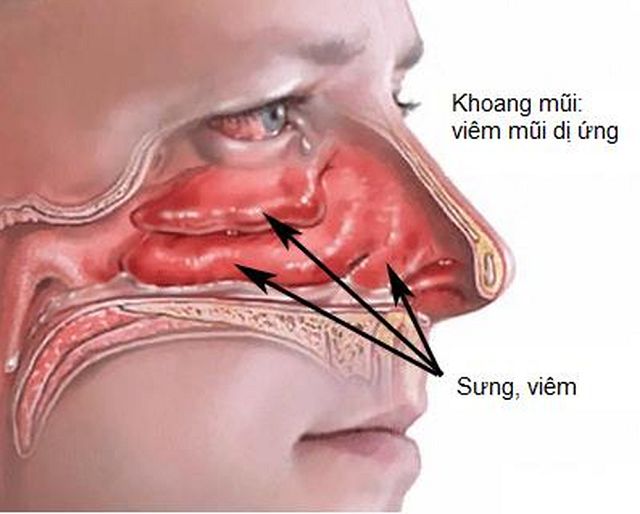 Mụn mọc trong mũi có thể gây viêm xoang