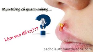 Cách trị mụn trứng cá quanh miệng