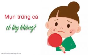 mụn trứng cá có lây không