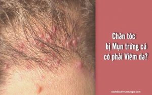 chân tóc bị mụn trứng cá