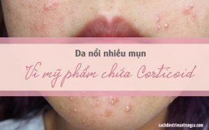 da nổi mụn vì mỹ phẩm có chứa chất Corticoid