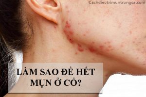 Cách trị mụn trứng cá ở cổ