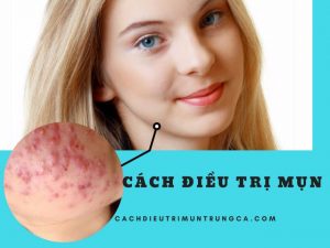 Cách điều trị mụn