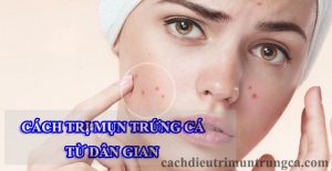 Trị mụn trứng cá bằng phương pháp dân gian