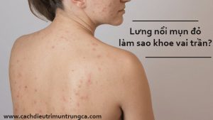 Lưng nổi mụn đỏ không có cồi, có phải do mụn trứng cá?