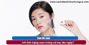 Mụn trứng cá bọc lâu ngày không khỏi phải làm sao?