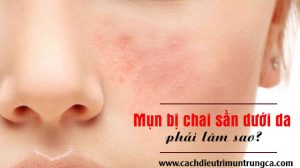 Phải làm gì khi mụn bị chai sần dưới da không thể xẹp được